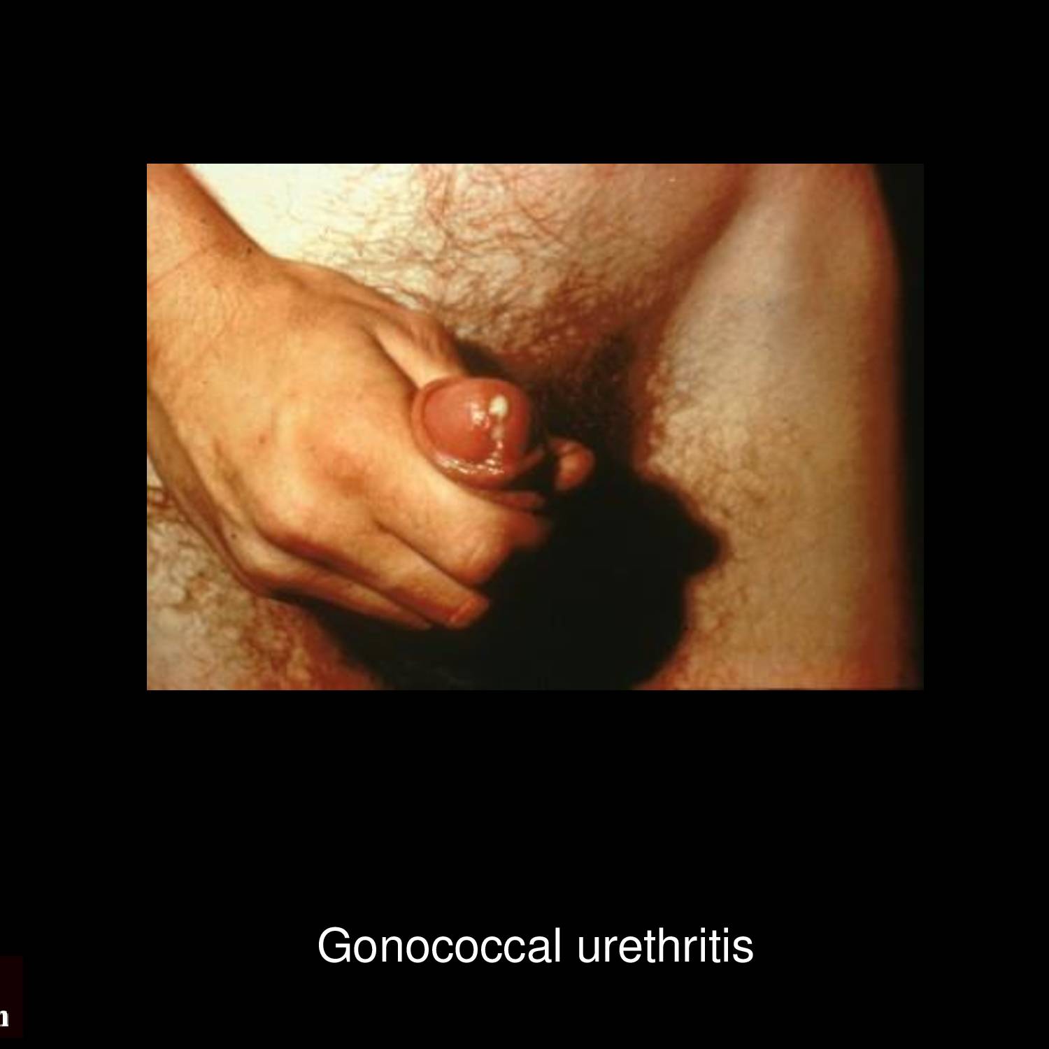 Gonococcal urethritis with profuse purulent urethral discharge in male patient showing characteristic yellow-green exudate caused by Neisseria gonorrhoeae