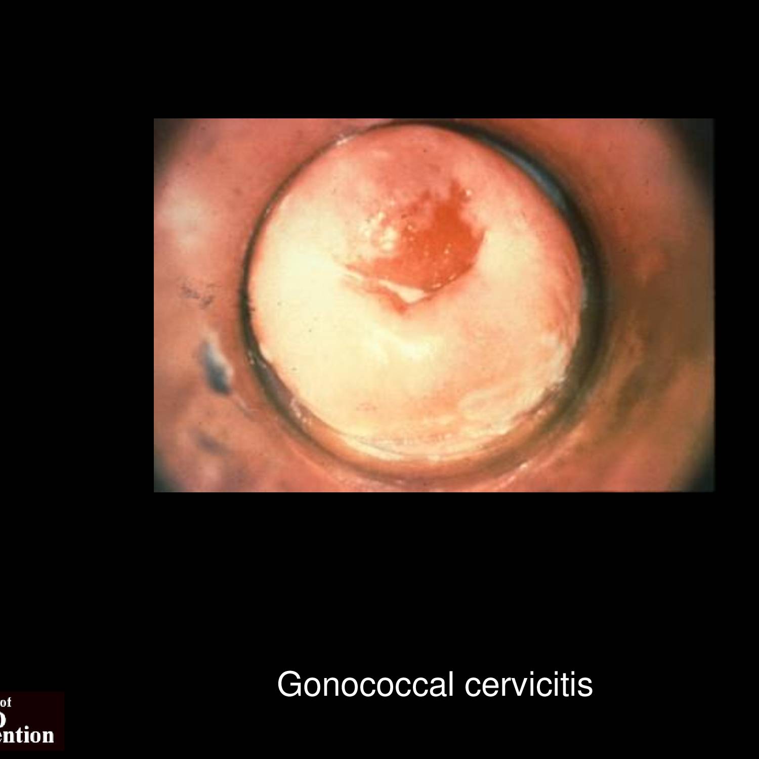 Gonococcal cervicitis showing mucopurulent cervical discharge and cervical erythema in female patient with Neisseria gonorrhoeae infection