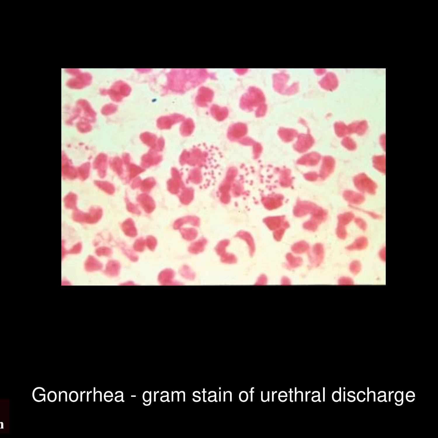 Gonococcal conjunctivitis with purulent eye discharge and conjunctival injection caused by Neisseria gonorrhoeae infection requiring urgent treatment