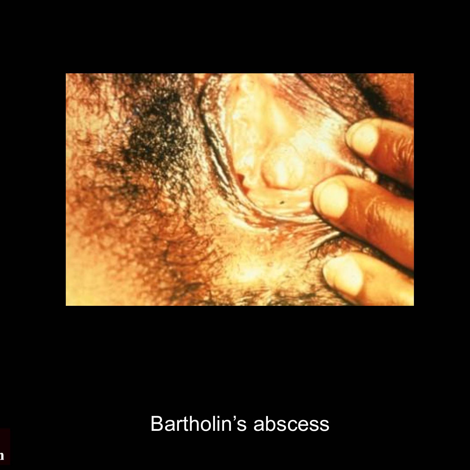 Disseminated gonococcal infection showing characteristic pustular dermatitis on extremities with hemorrhagic pustules and surrounding erythema