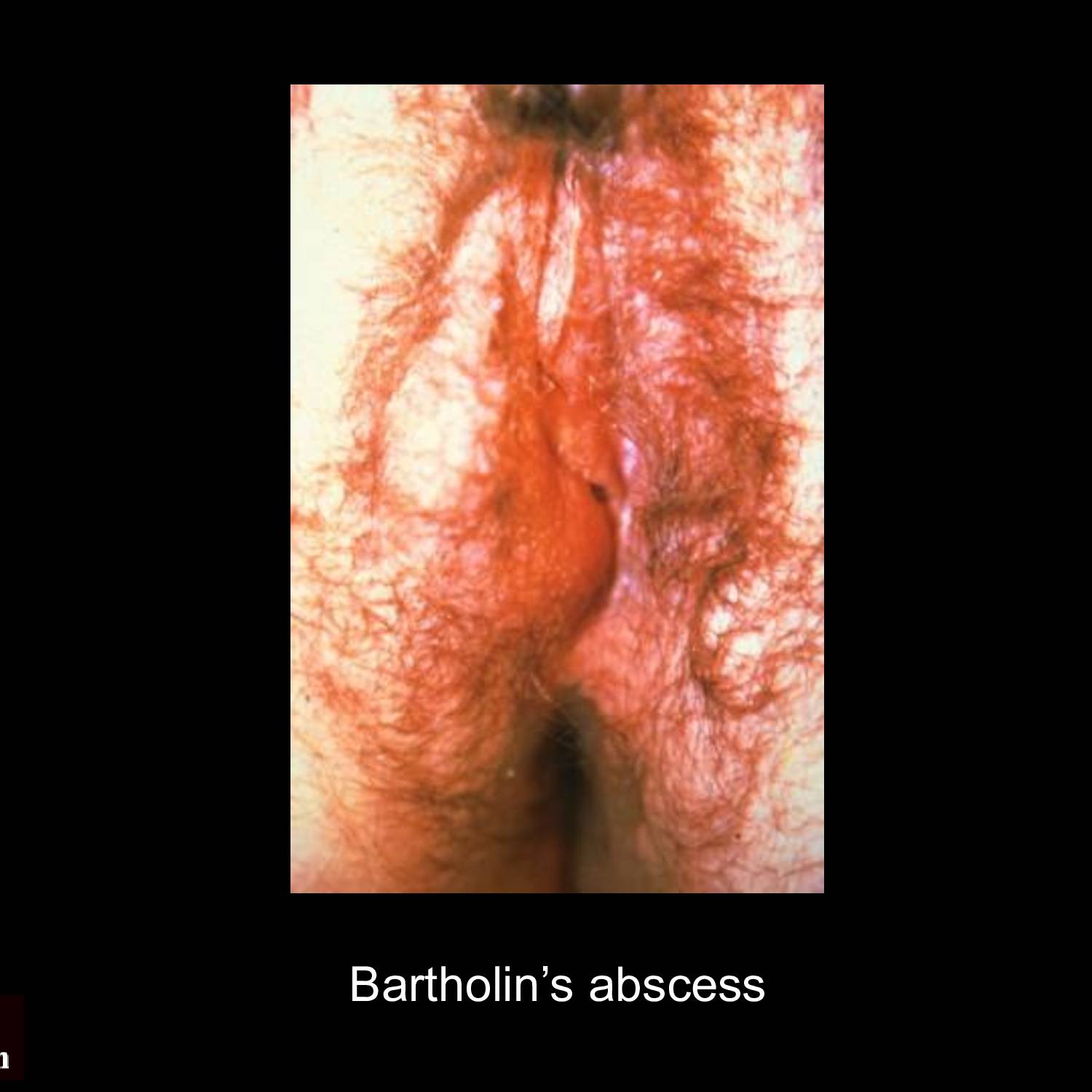 Gonococcal arthritis with swollen erythematous knee joint as manifestation of disseminated Neisseria gonorrhoeae infection