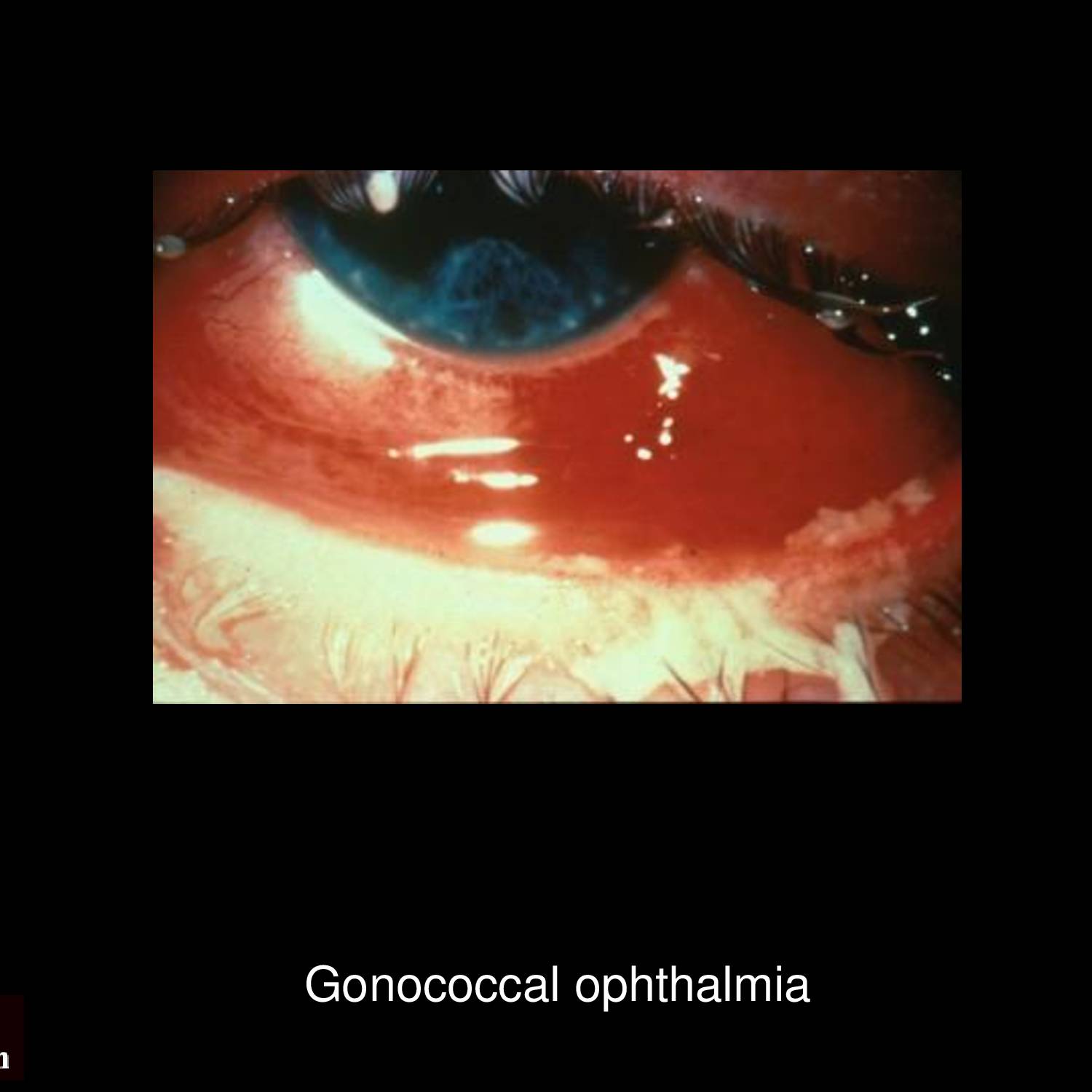 Gonococcal urethritis specimen Gram stain showing gram-negative intracellular diplococci in polymorphonuclear leukocytes diagnostic of Neisseria gonorrhoeae