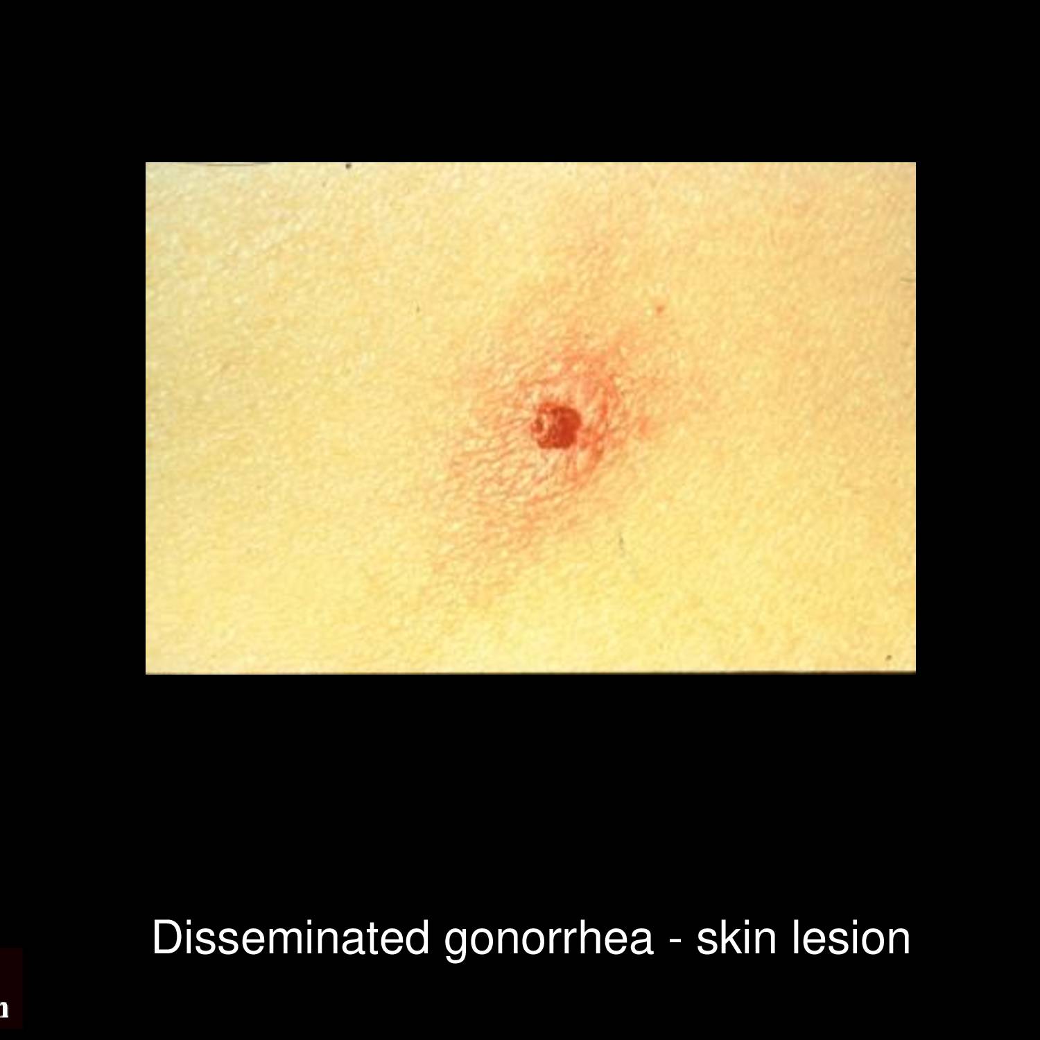Gonococcal pharyngitis with erythematous pharynx and exudative tonsillitis caused by Neisseria gonorrhoeae through oral sexual contact