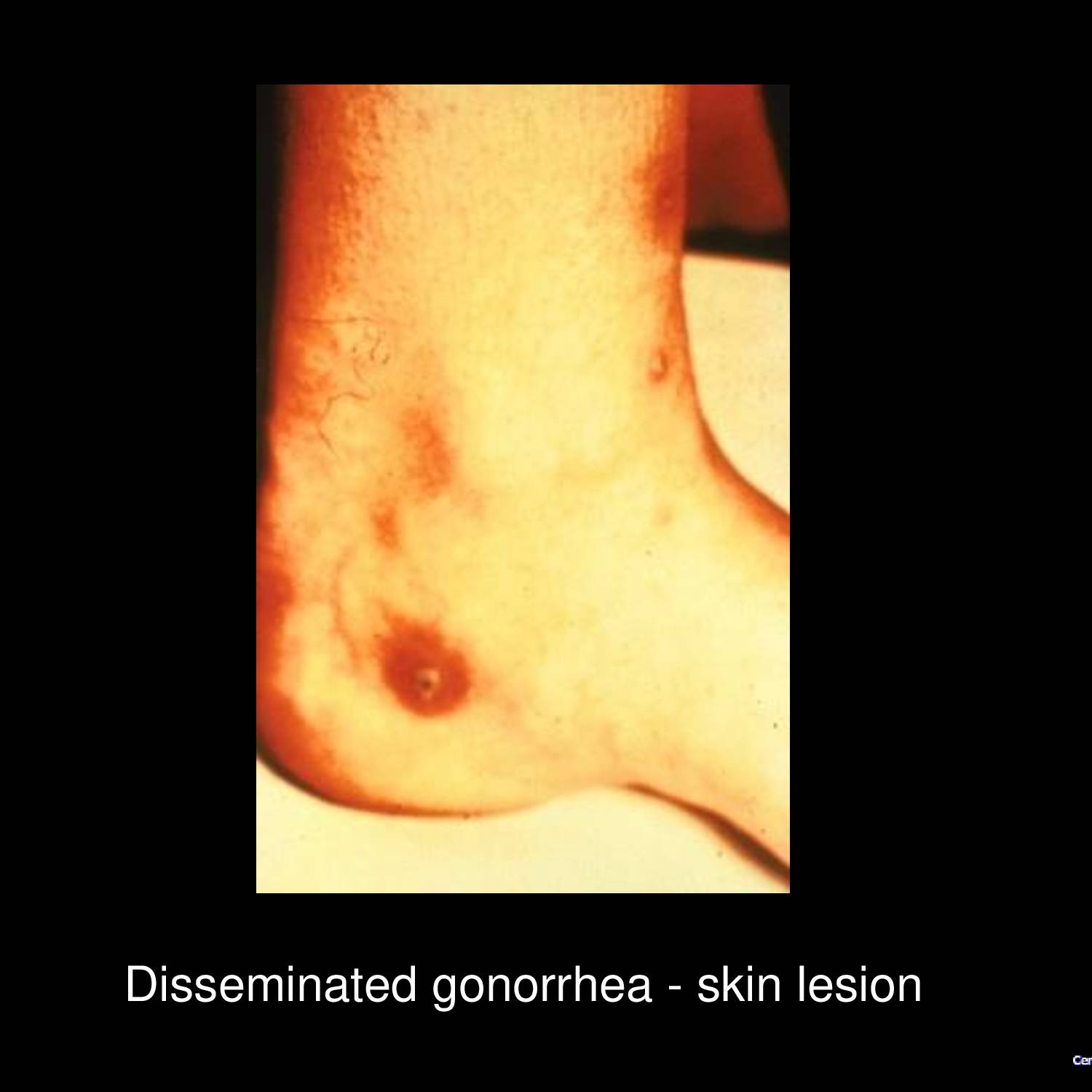 Gonococcal skin lesions on trunk showing characteristic pustular and hemorrhagic lesions of disseminated gonococcal infection with erythematous halos