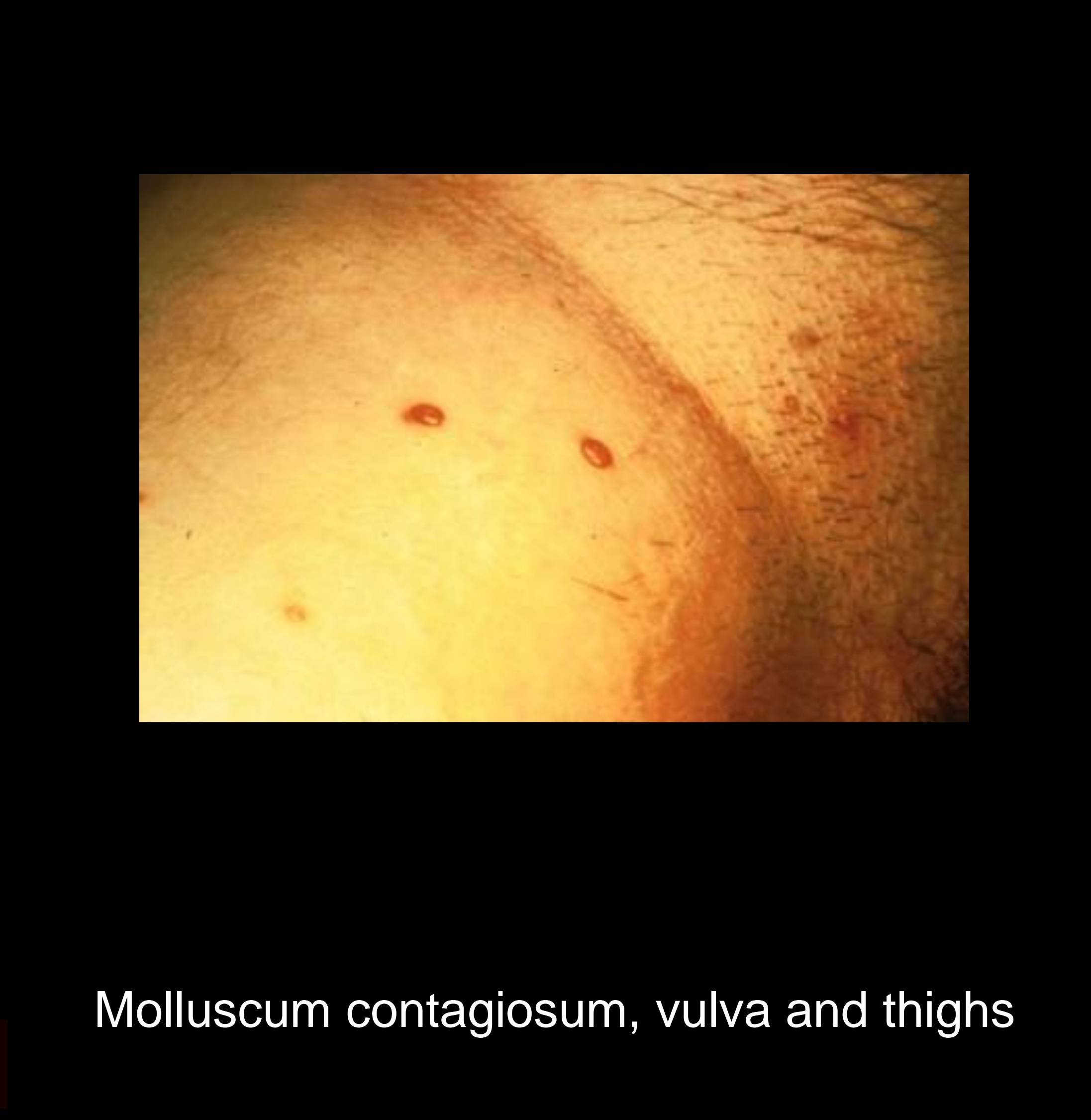 Molluscum contagiosum papules on genital area showing characteristic dome-shaped flesh-colored lesions with central umbilication caused by MCV poxvirus