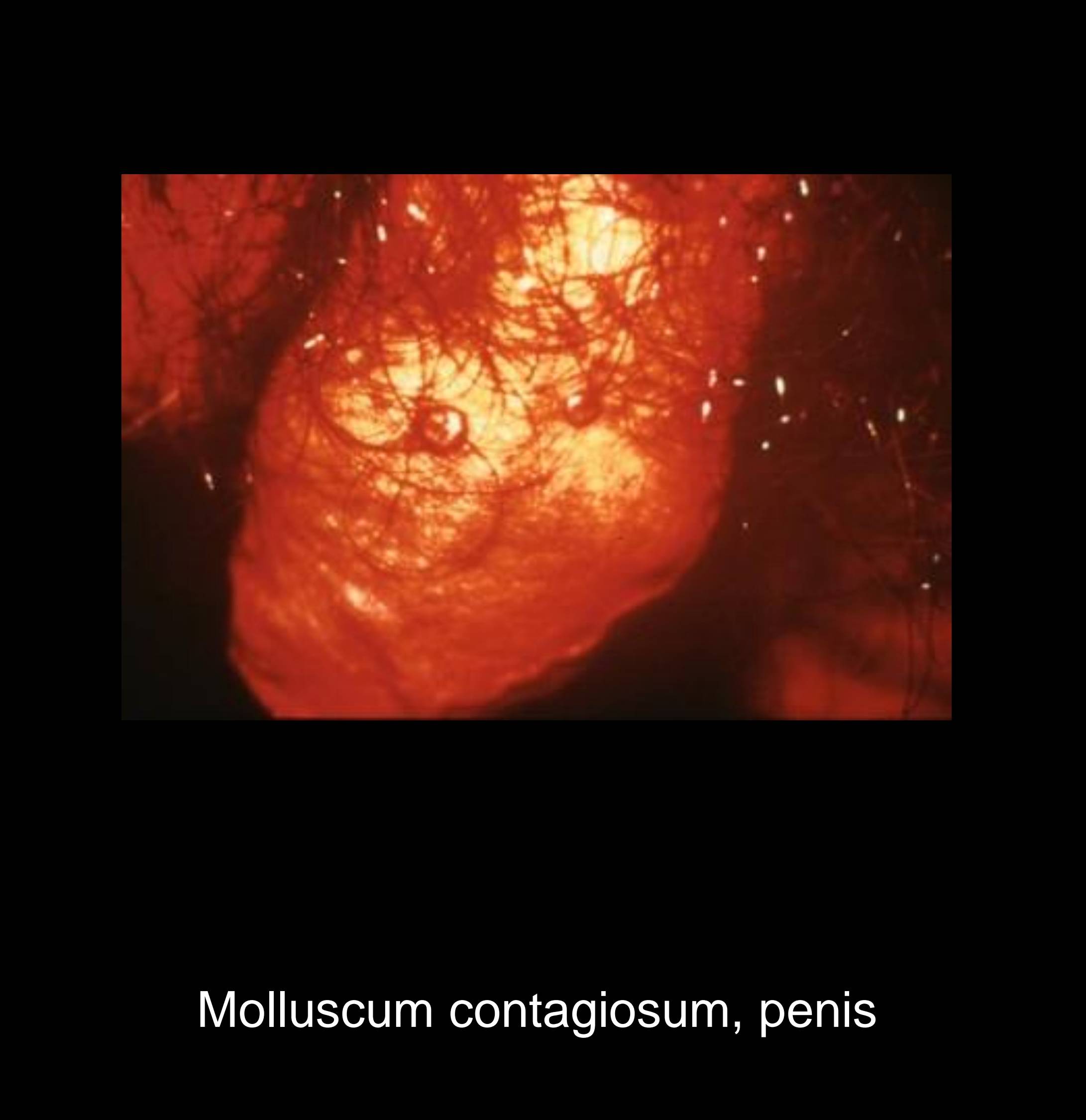 Multiple molluscum contagiosum lesions on lower abdomen and pubic area showing clustered pearly papules with central dimples from poxvirus infection