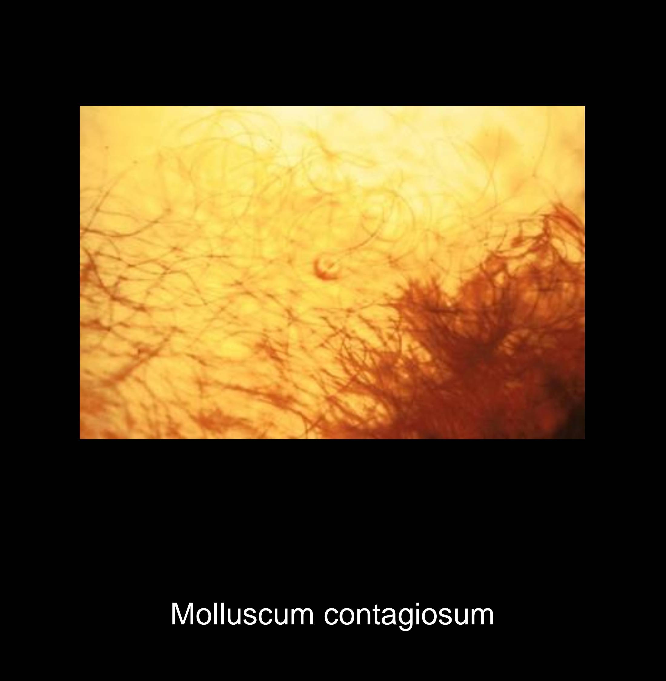Giant molluscum contagiosum lesions in immunocompromised patient showing unusually large papules with pronounced central umbilication and surrounding inflammation