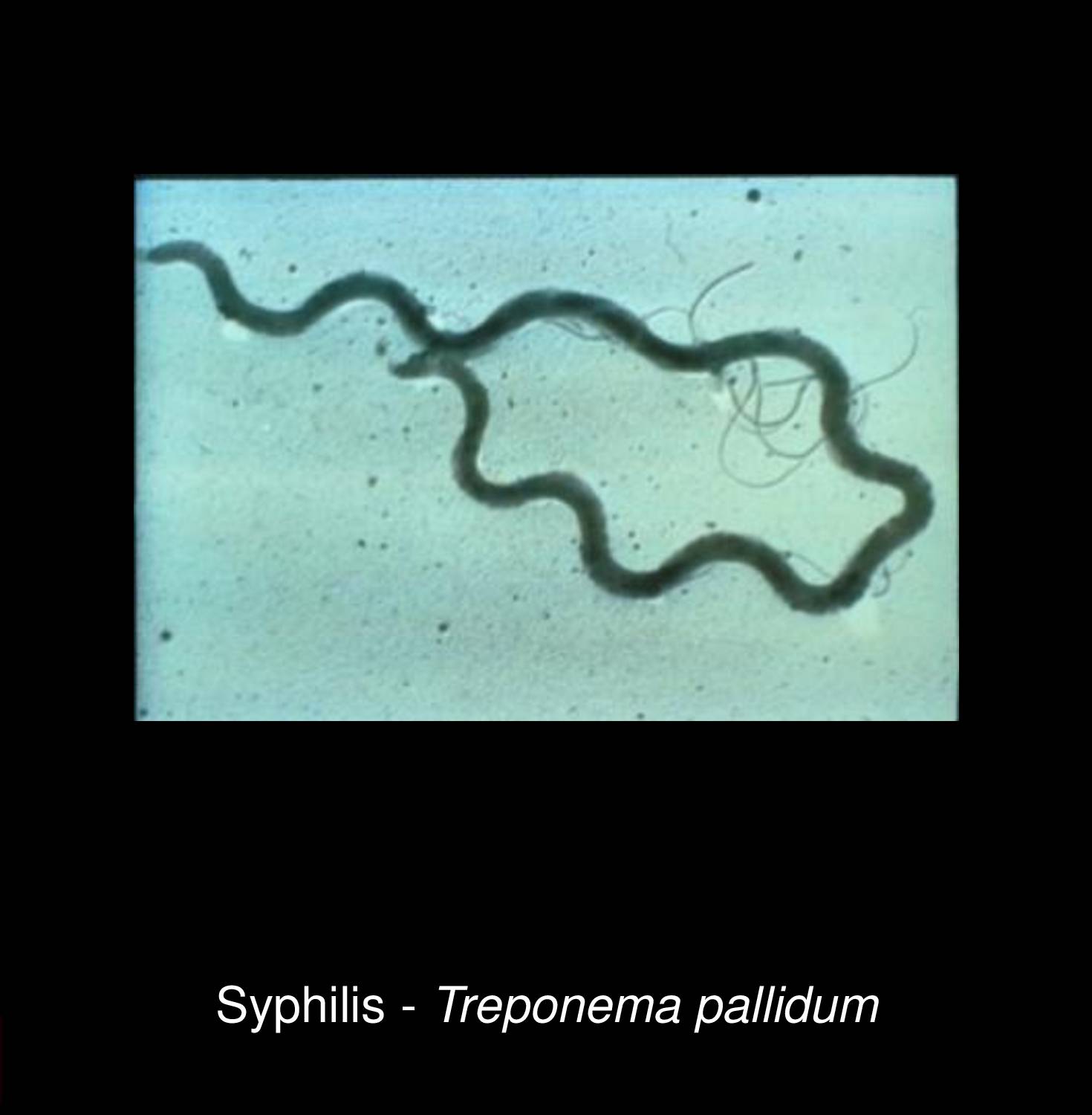 Syphilis - STD Nepal clinic, diagnosed by Dr. GP Yadav